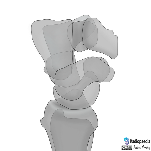 File:Normal wrist alignment, dorsal and volar intercalated segmental instability (illustration) (Radiopaedia 80949-94486 A 4).png