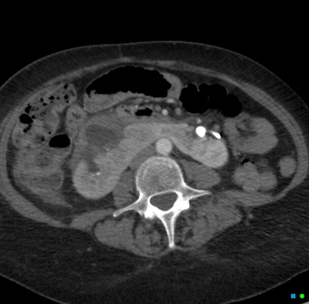 File:Obstructed infected horseshoe kidney (Radiopaedia 18116-17898 B 18).jpg