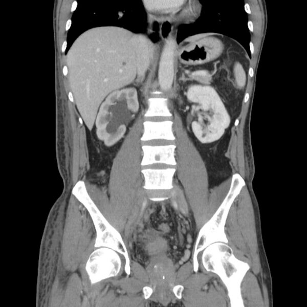 File:Obstructive bladder transitional cell carcinoma (Radiopaedia 9825-10410 B 14).jpg