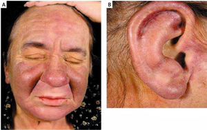 a)Skin infiltration face b) ear
