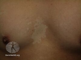 Pityriasis versicolor: light well-defined marks
