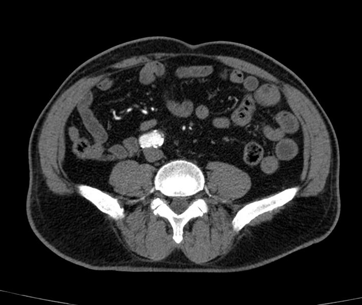 File:Abdominal aortic aneurysm (Radiopaedia 22421-22458 C+ arterial phase 58).jpg