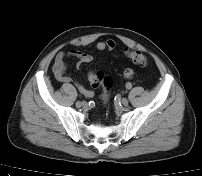 File:Abdominal aortic aneurysm (Radiopaedia 22421-22458 non-contrast 44).jpg
