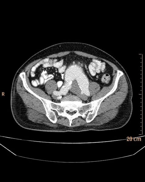 File:Abdominal aortic aneurysm (Radiopaedia 25985-26121 Axial C+ arterial phase 31).jpg