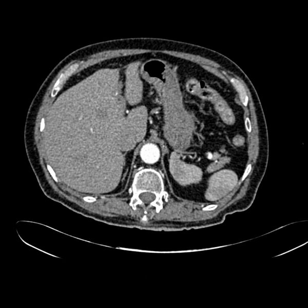 File:Abdominal aortic aneurysm (Radiopaedia 75131-86203 Axial C+ arterial phase 11).jpg