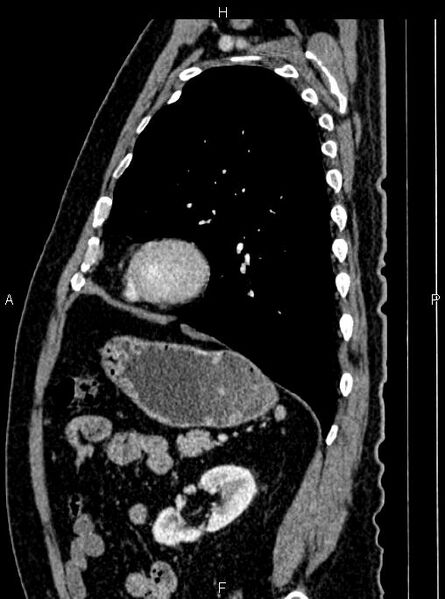 File:Abdominal aortic aneurysm (Radiopaedia 83094-97462 Sagittal renal cortical phase 89).jpg