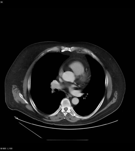File:Abdominal aortic aneurysm with intramural hematoma then rupture (Radiopaedia 50278-55631 Axial C+ arterial phase 29).jpg
