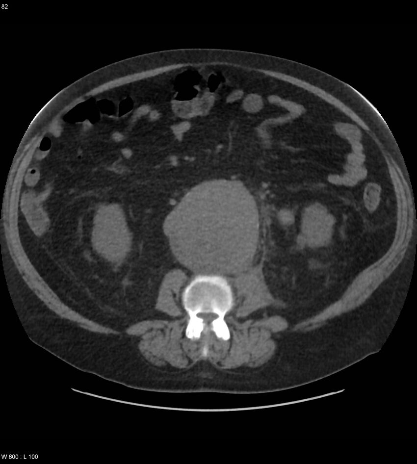Abdominal aortic aneurysm with intramural hematoma then rupture (Radiopaedia 50278-55631 Axial non-contrast 78).jpg