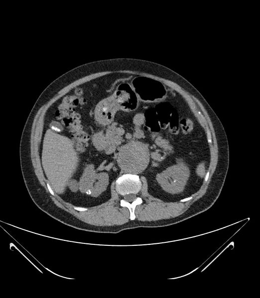 File:Abdominal aortic aneurysm with thrombus fissuration (Radiopaedia 46218-50618 Axial non-contrast 18).jpg