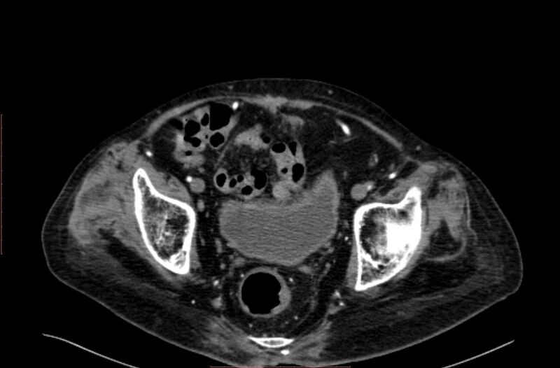 File:Abdominal aortic interposition tube graft and aneurysm thrombosis (Radiopaedia 71438-81857 Axial C+ arterial phase 209).jpg