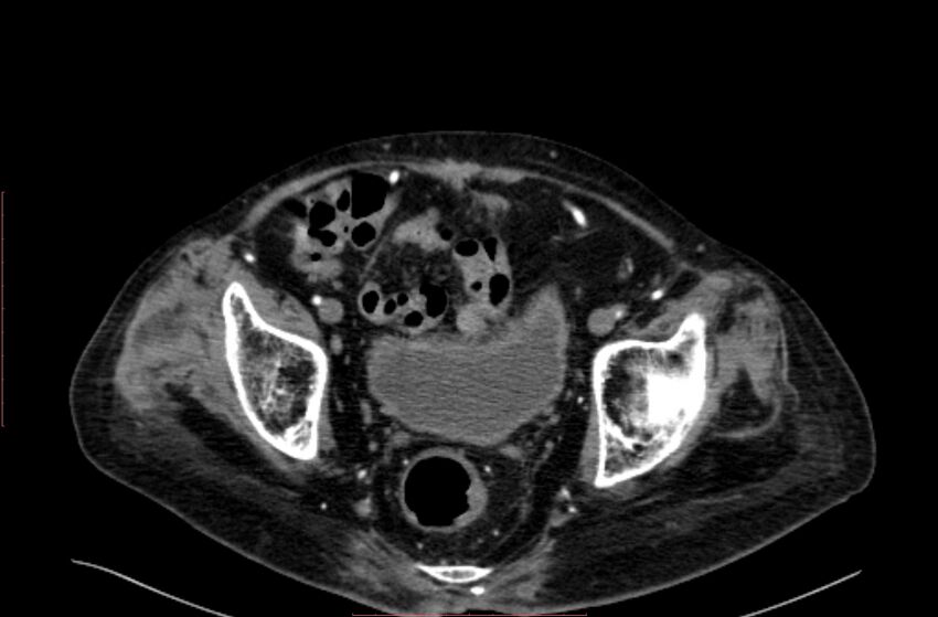 Abdominal aortic interposition tube graft and aneurysm thrombosis (Radiopaedia 71438-81857 Axial C+ arterial phase 209).jpg