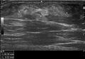 Accessory breast tissue (axilla) (Radiopaedia 76956).jpg