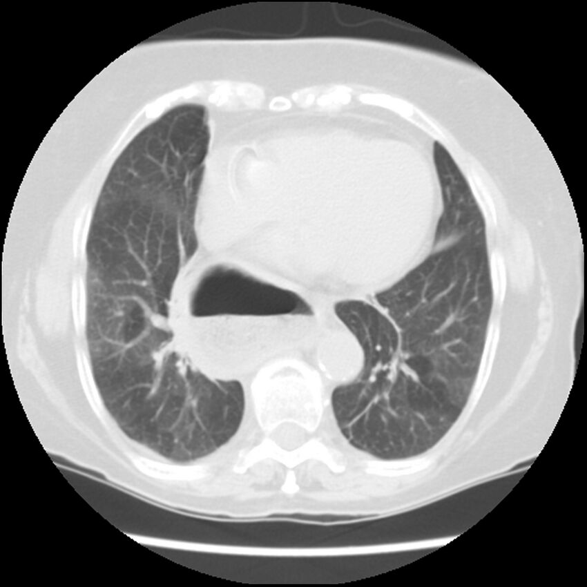 Achalasia (Radiopaedia 44094-47649 Axial lung window 40).jpg