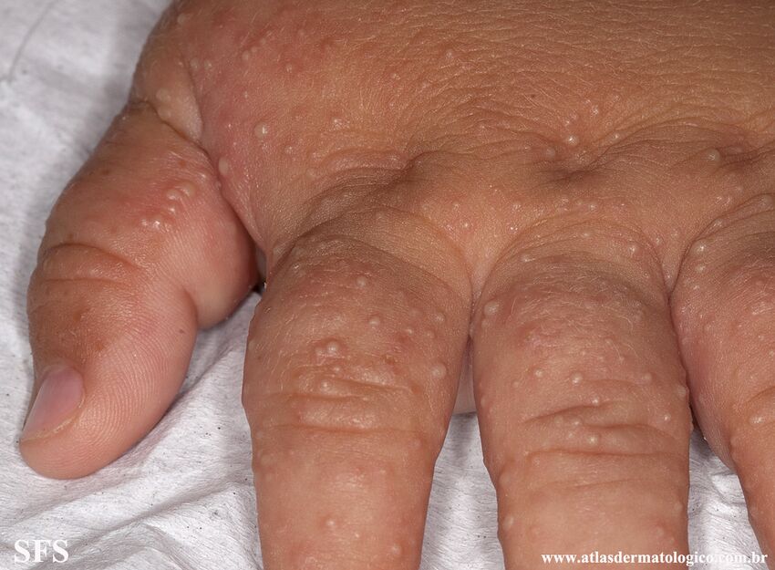 Acropustulosis Infantile (Dermatology Atlas 8).jpg