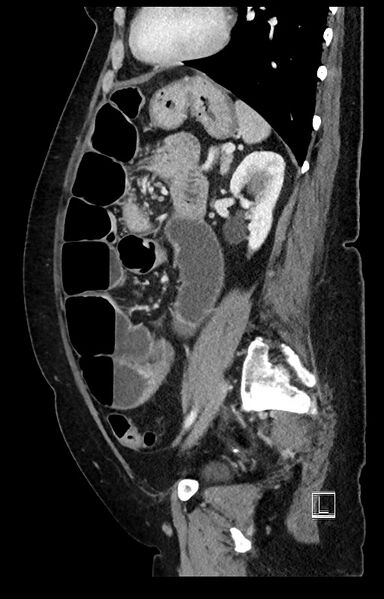 File:Active Crohn disease (Radiopaedia 59394-66750 Sagittal C+ portal venous phase 20).jpg
