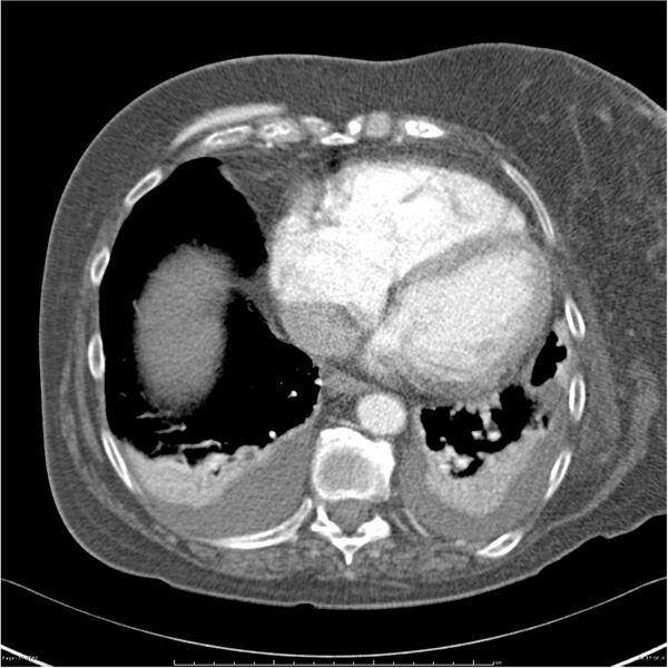 File:Acute-on-chronic pulmonary emboli (Radiopaedia 27925-28169 C+ CTPA 57).jpg