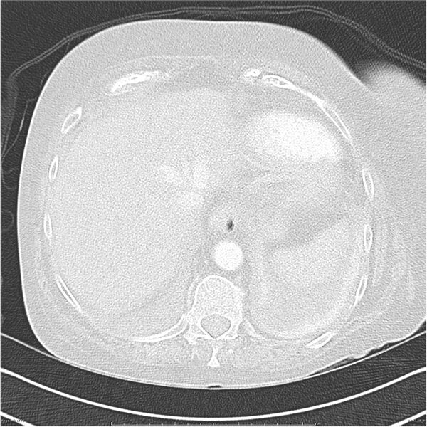 File:Acute-on-chronic pulmonary emboli (Radiopaedia 27925-28169 lung window 42).jpg