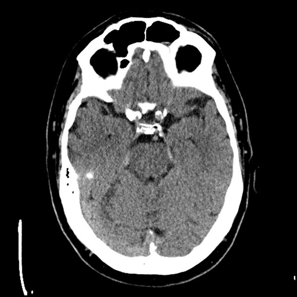 File:Acute A3 occlusion with ACA ischemic penumbra (CT perfusion) (Radiopaedia 72036-82525 Axial non-contrast 15).jpg