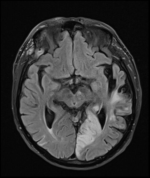 File:Acute P1 occlusion with PCA ischemia penumbra (CT perfusion) (Radiopaedia 72084-82590 Axial FLAIR 16).jpg