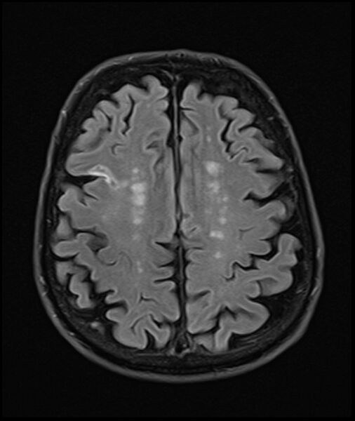 File:Acute P1 occlusion with PCA ischemia penumbra (CT perfusion) (Radiopaedia 72084-82590 Axial FLAIR 28).jpg