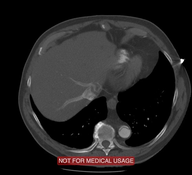 File:Acute aortic dissection - Stanford type A (Radiopaedia 40661-43285 Axial C+ arterial phase 61).jpg