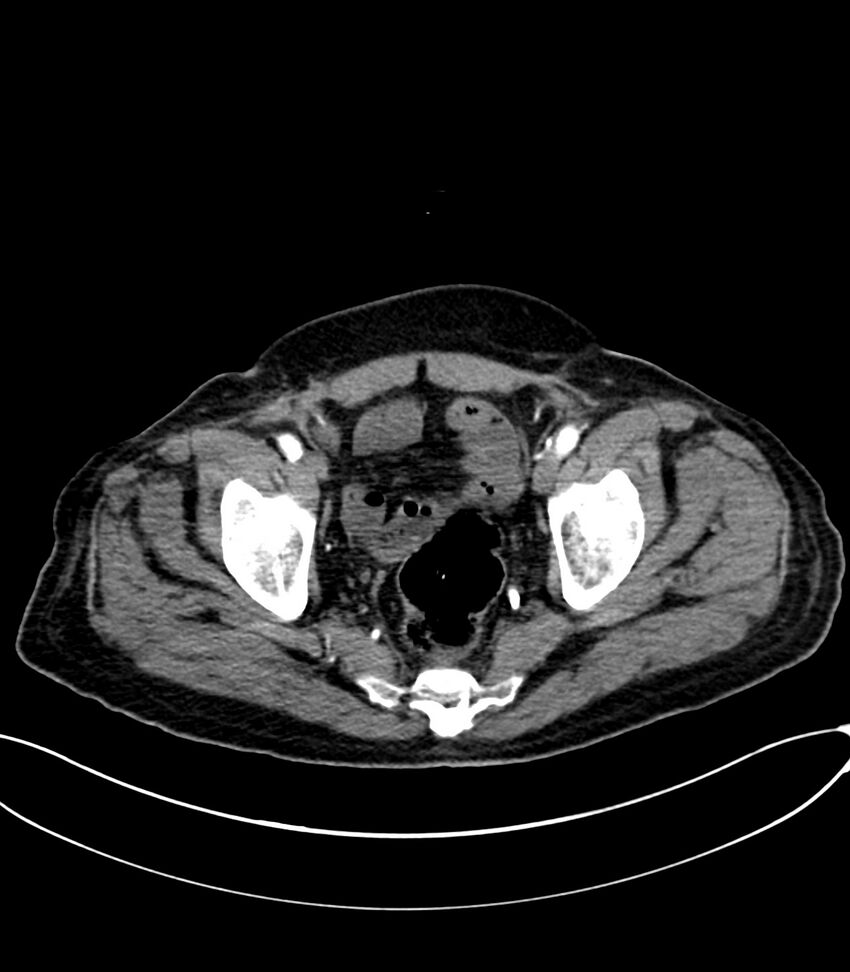 Acute arterial mesenteric ischemia (Radiopaedia 78238-90828 Axial C+ arterial phase 125).jpg