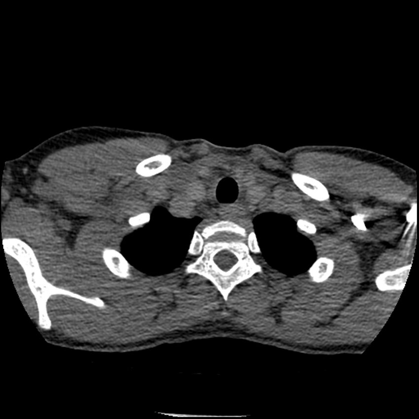 Acute chest syndrome - sickle cell disease (Radiopaedia 42375-45499 Axial C+ CTPA 20).jpg