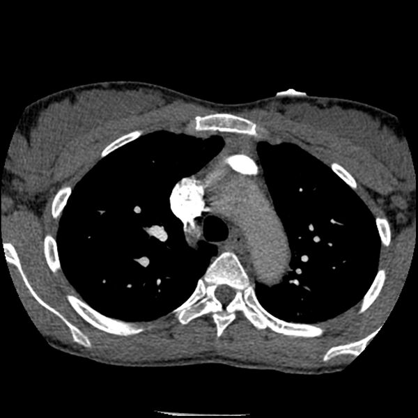 File:Acute chest syndrome - sickle cell disease (Radiopaedia 42375-45499 Axial C+ CTPA 57).jpg