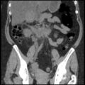 Acute cholecystitis and ureteric colic (Radiopaedia 42330-45444 Coronal prone 52).jpg