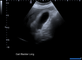Acute cholecystitis with incidental hepatic hemangioma (Radiopaedia 46322).png