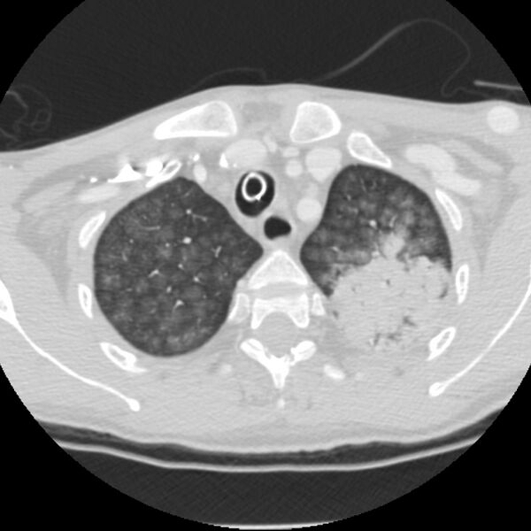 File:Acute diffuse alveolar hemorrhage (Radiopaedia 41323-44158 Axial lung window 7).jpg