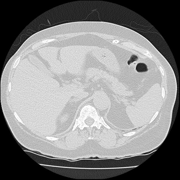 File:Acute interstitial pneumonitis (Radiopaedia 45404-49452 Axial lung window 92).jpg
