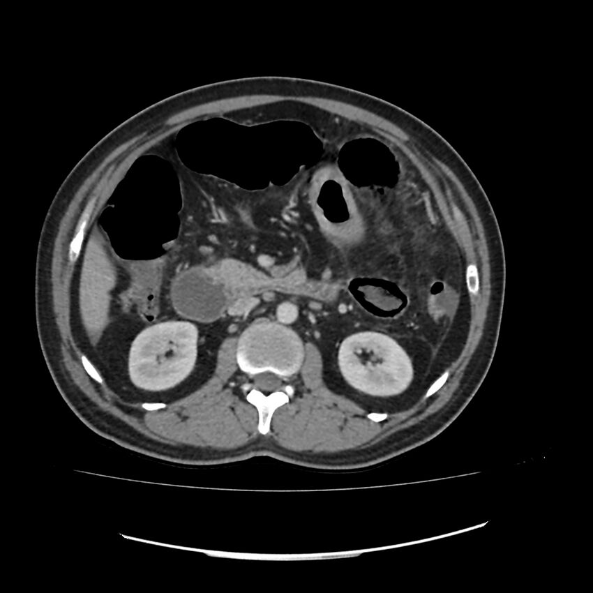 Acute mesenteric ischemia - superior mesenteric artery thrombosis (Radiopaedia 73947-84776 Axial C+ portal venous phase 51).jpg