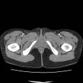 Acute myocarditis (Radiopaedia 55988-62613 Axial C+ portal venous phase 87).jpg