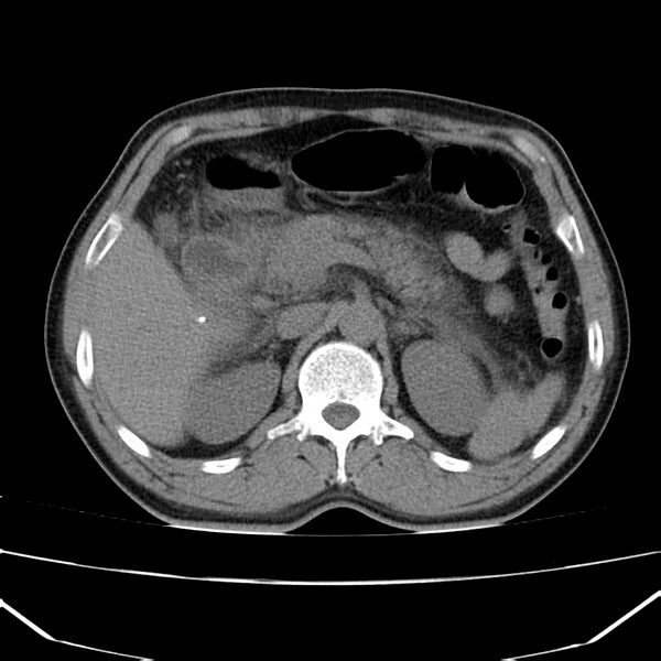 File:Acute pancreatitis (Radiopaedia 22572-22596 Axial non-contrast 21).jpg