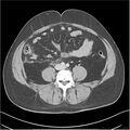 Acute pancreatitis - mild (Radiopaedia 27796-28033 C+ portal venous phase 39).jpg
