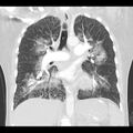 Acute pulmonary edema on CT (Radiopaedia 33582-34672 Coronal lung window 20).jpg