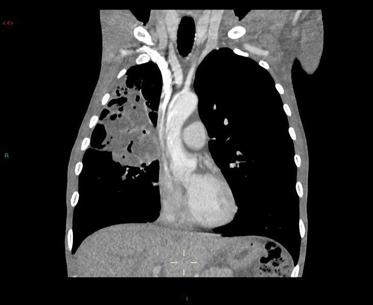 File:Acute right lung abscess (Radiopaedia 34806-36258 Coronal C+ arterial phase 35).jpg