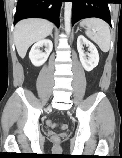 File:Acute uncomplicated appendicitis (Radiopaedia 88350-104982 Coronal C+ portal venous phase 33).png