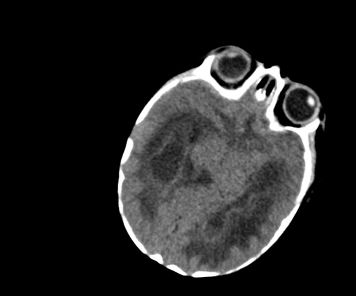 File:Acute ventriculitis (Radiopaedia 57502-64459 Axial non-contrast 8).jpg