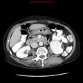 Adenocarcinoma of the colon (Radiopaedia 8191-9039 Axial liver window 32).jpg