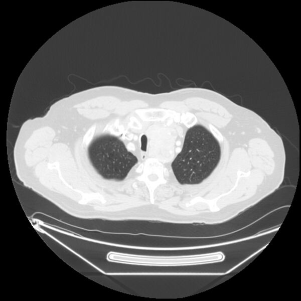 File:Adenocarcinoma of the lung (Radiopaedia 44876-48759 Axial lung window 8).jpg