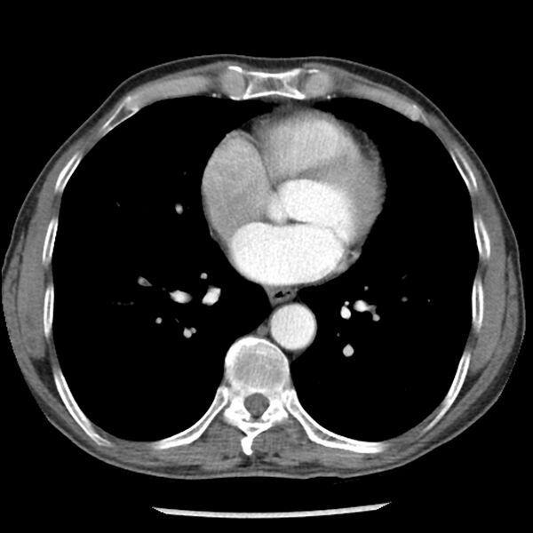 File:Adenocarcinoma of the lung - micropapillary predominant (Radiopaedia 42446-45563 Axial C+ portal venous phase 47).jpg