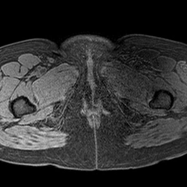File:Adenomyoma of the uterus (Radiopaedia 9871-10439 Axial T1 fat sat 1).jpg