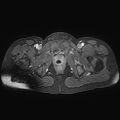 Adenomyoma of the uterus (huge) (Radiopaedia 9870-10438 Axial T1 C+ fat sat 6).jpg