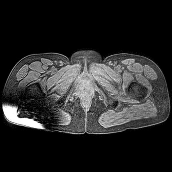 File:Adenomyoma of the uterus (huge) (Radiopaedia 9870-10438 Axial T1 fat sat 3).jpg