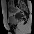 Adenomyosis and endometriotic cysts (Radiopaedia 82300-96367 Sagittal T2 4).jpg