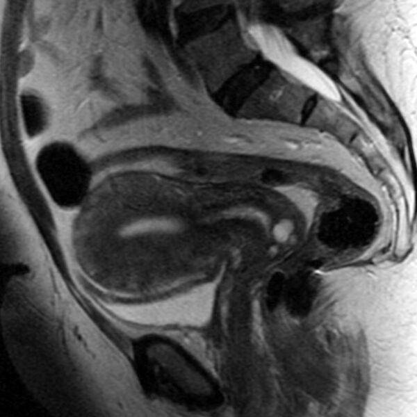 File:Adenomyosis of the uterus (Radiopaedia 9869-10437 Sagittal T2 5).jpg