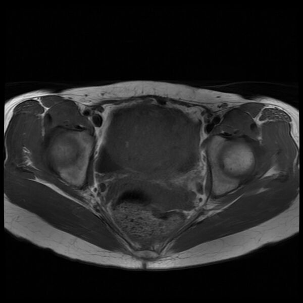 File:Adenomyosis on MRI (Radiopaedia 29328-29780 Axial T1 7).jpg