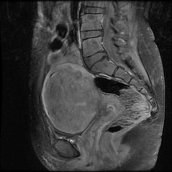 File:Adenomyosis on MRI (Radiopaedia 29328-29780 Sagittal T1 C+ fat sat 9).jpg